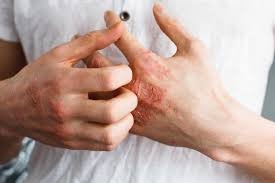 Ngứa sau bỏng: Một số biện pháp điều trị tại nhà