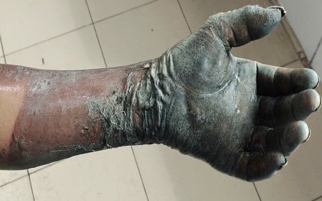 Hiểm họa từ thuốc pháo tự chế